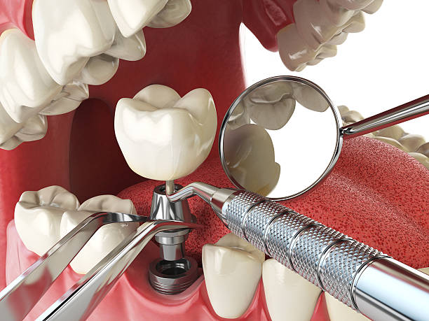 Best Emergency Dental Filling Replacement  in Glasgow, DE